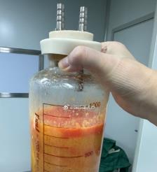 日照水动力吸脂手术要做多久？